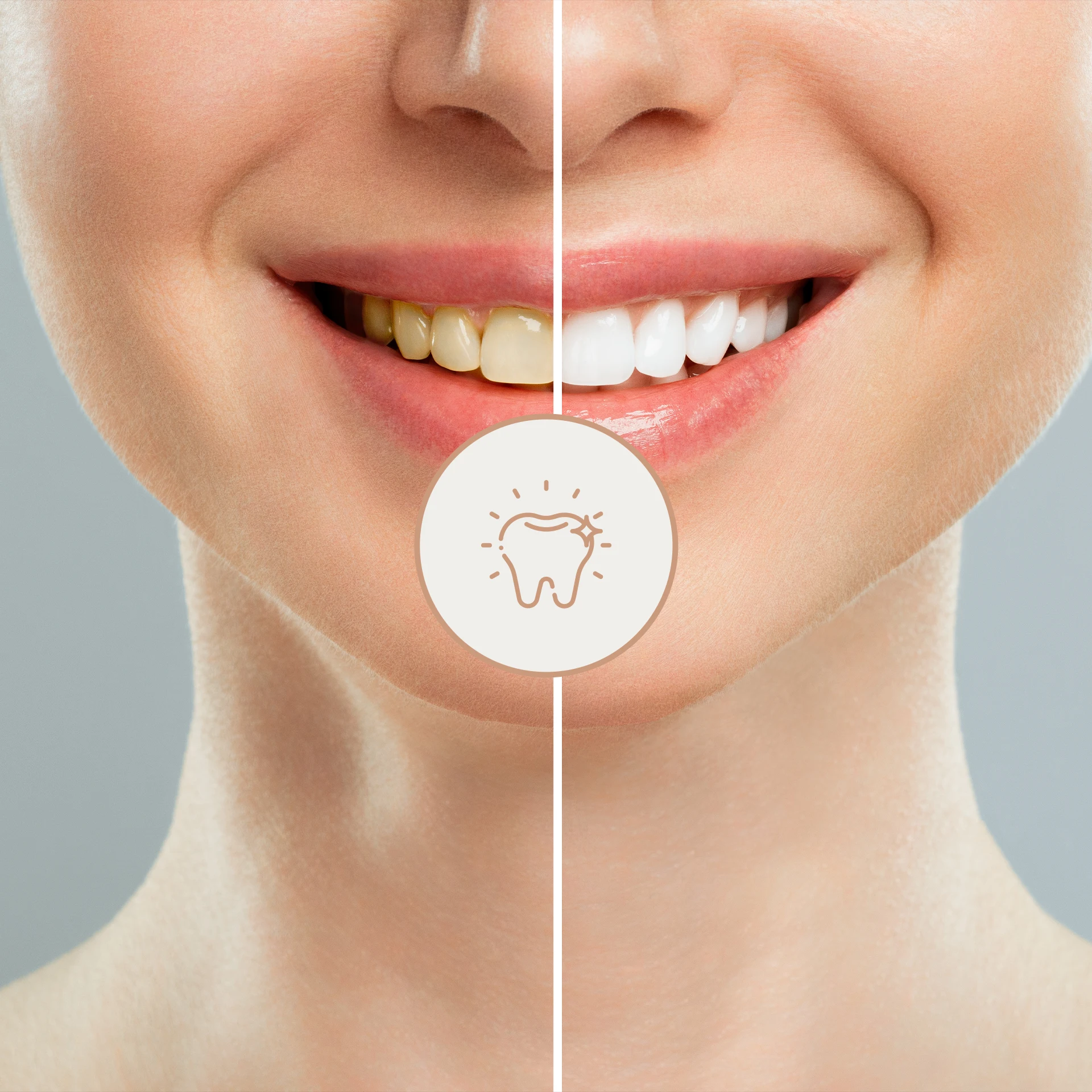 Ιατρείο Τσουμής εικόνα πριν και μετά χαμόγελο λεύκανση